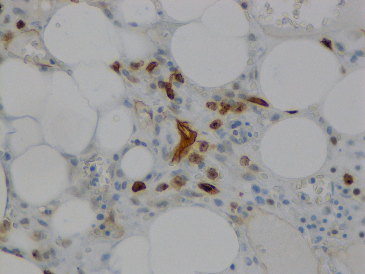 Bone marrow biopsy: CD34 immunostain #1
